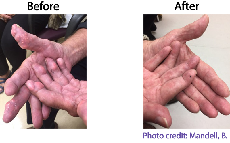 Before and After Treatment with Pegloticase – Gout Study Group